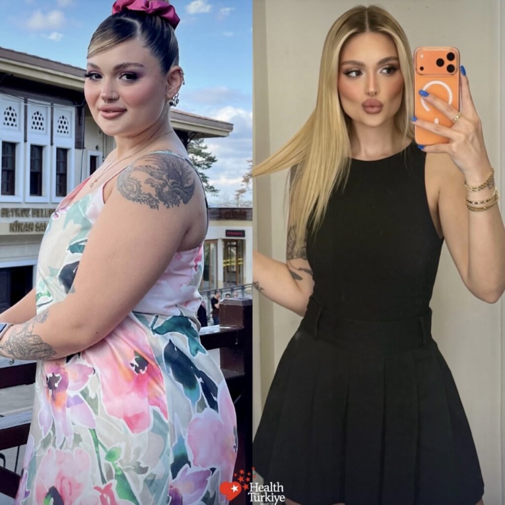 before after 1
